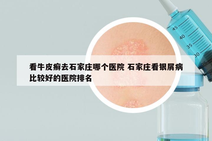 看牛皮癣去石家庄哪个医院 石家庄看银屑病比较好的医院排名