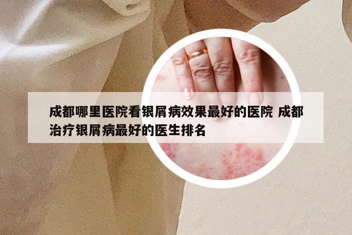 成都哪里医院看银屑病效果最好的医院 成都治疗银屑病最好的医生排名