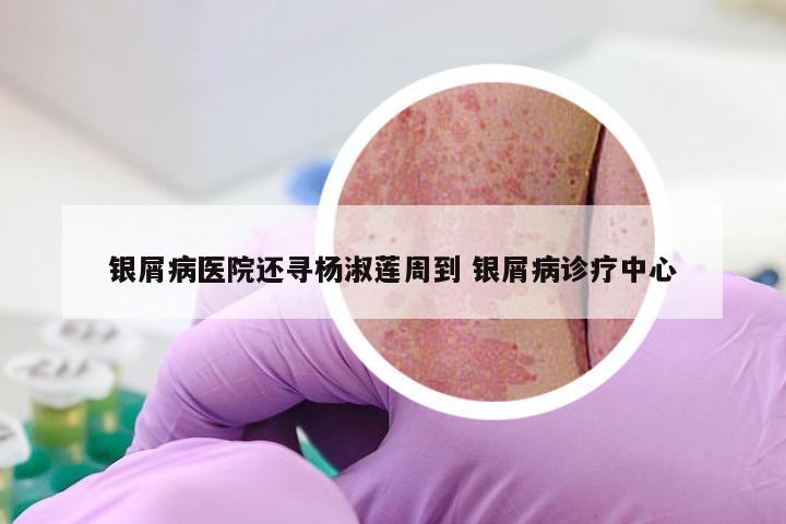 银屑病医院还寻杨淑莲周到 银屑病诊疗中心