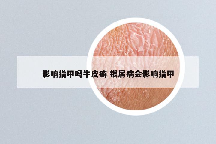 影响指甲吗牛皮癣 银屑病会影响指甲