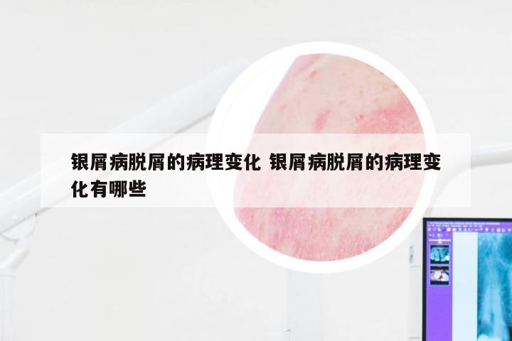 银屑病脱屑的病理变化 银屑病脱屑的病理变化有哪些