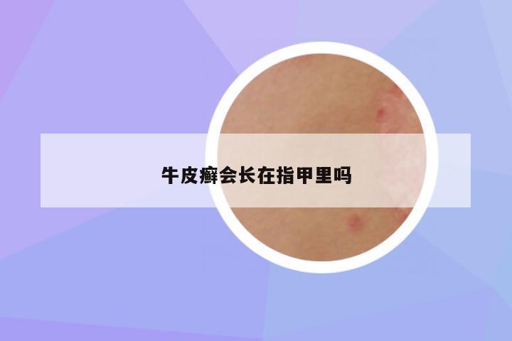 牛皮癣会长在指甲里吗