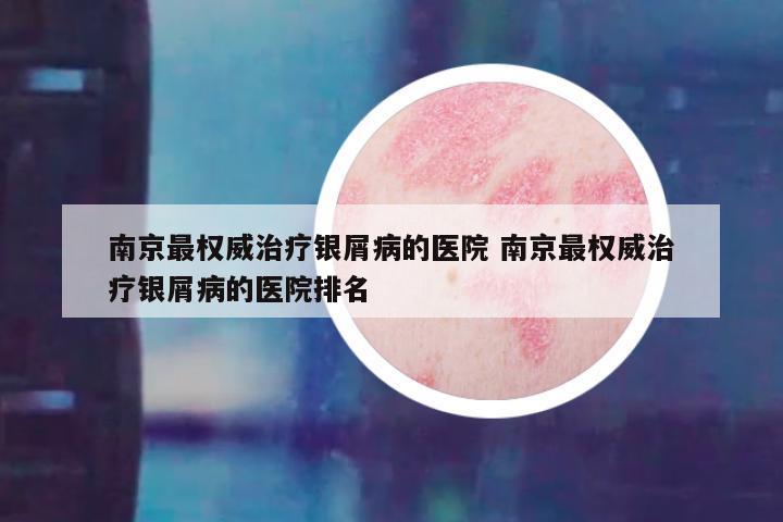南京最权威治疗银屑病的医院 南京最权威治疗银屑病的医院排名