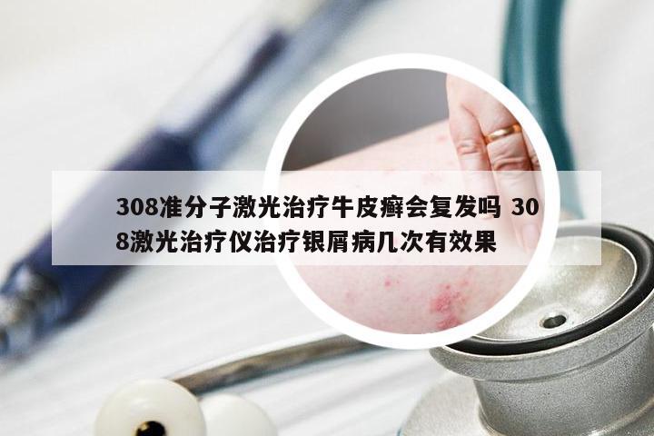 308准分子激光治疗牛皮癣会复发吗 308激光治疗仪治疗银屑病几次有效果