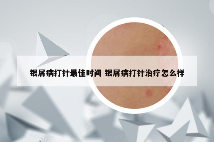 银屑病打针最佳时间 银屑病打针治疗怎么样
