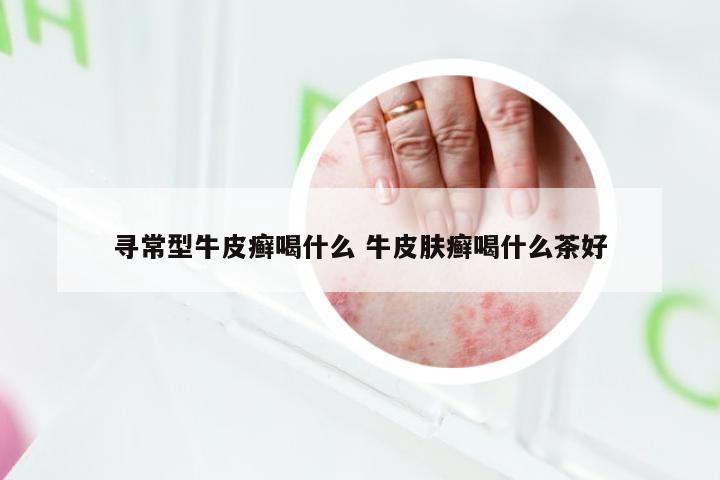 寻常型牛皮癣喝什么 牛皮肤癣喝什么茶好