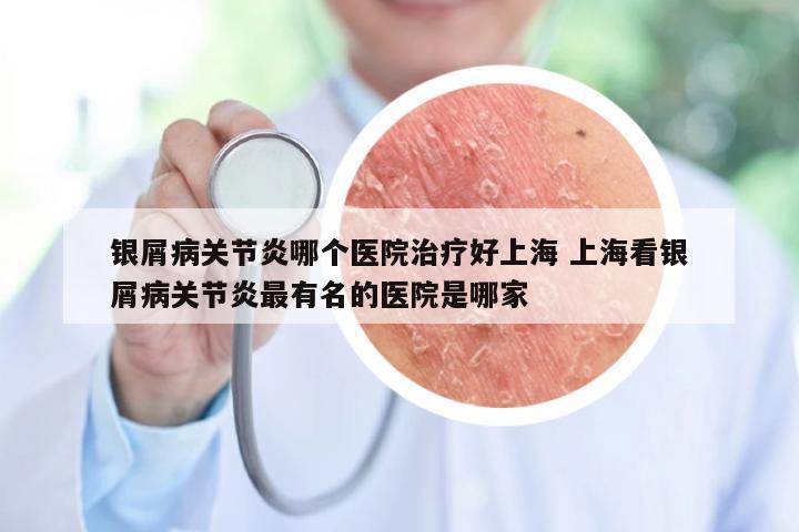 银屑病关节炎哪个医院治疗好上海 上海看银屑病关节炎最有名的医院是哪家