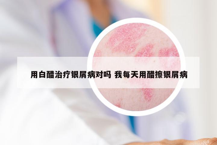 用白醋治疗银屑病对吗 我每天用醋擦银屑病