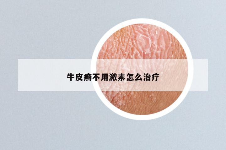 牛皮癣不用激素怎么治疗