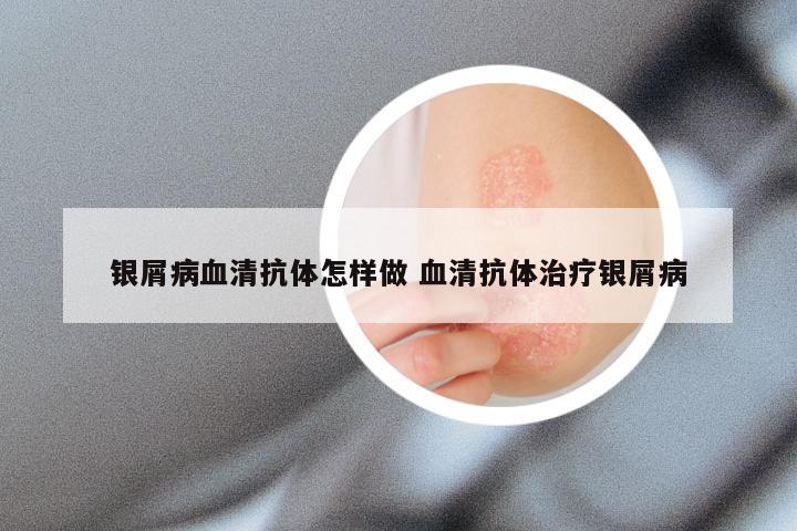 银屑病血清抗体怎样做 血清抗体治疗银屑病