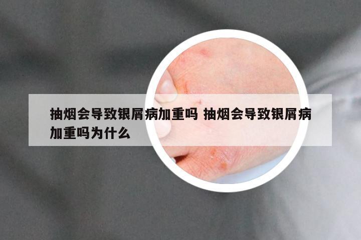 抽烟会导致银屑病加重吗 抽烟会导致银屑病加重吗为什么