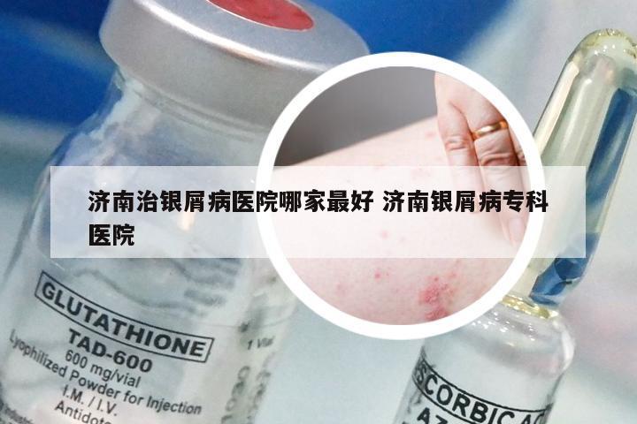 济南治银屑病医院哪家最好 济南银屑病专科医院