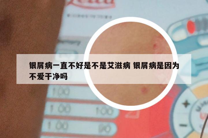银屑病一直不好是不是艾滋病 银屑病是因为不爱干净吗