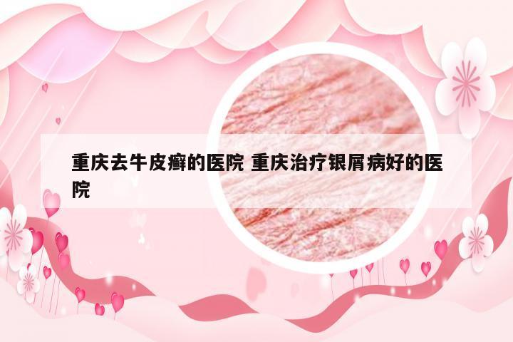 重庆去牛皮癣的医院 重庆治疗银屑病好的医院