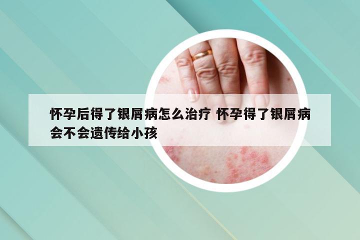 怀孕后得了银屑病怎么治疗 怀孕得了银屑病会不会遗传给小孩