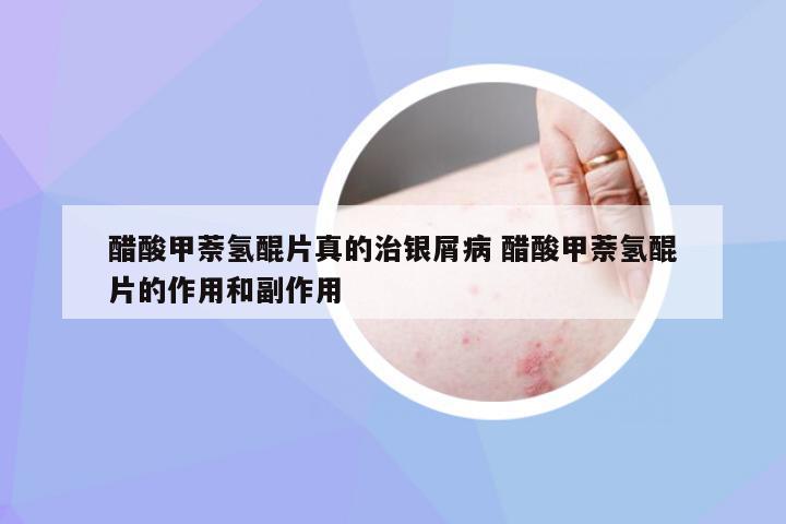 醋酸甲萘氢醌片真的治银屑病 醋酸甲萘氢醌片的作用和副作用