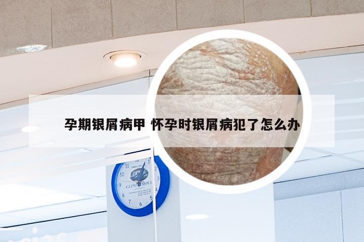 孕期银屑病甲 怀孕时银屑病犯了怎么办