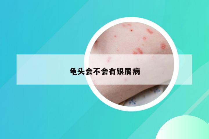 龟头会不会有银屑病