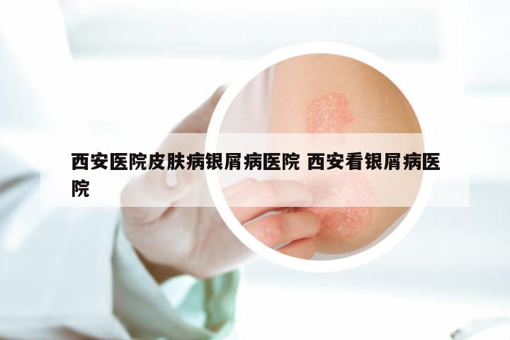 西安医院皮肤病银屑病医院 西安看银屑病医院