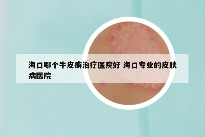 海口哪个牛皮癣治疗医院好 海口专业的皮肤病医院