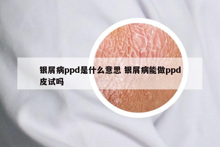 银屑病ppd是什么意思 银屑病能做ppd皮试吗