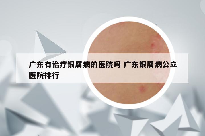 广东有治疗银屑病的医院吗 广东银屑病公立医院排行