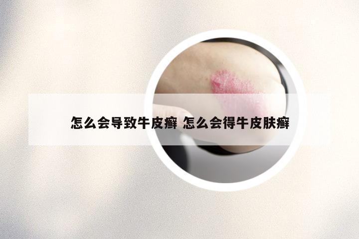 怎么会导致牛皮癣 怎么会得牛皮肤癣
