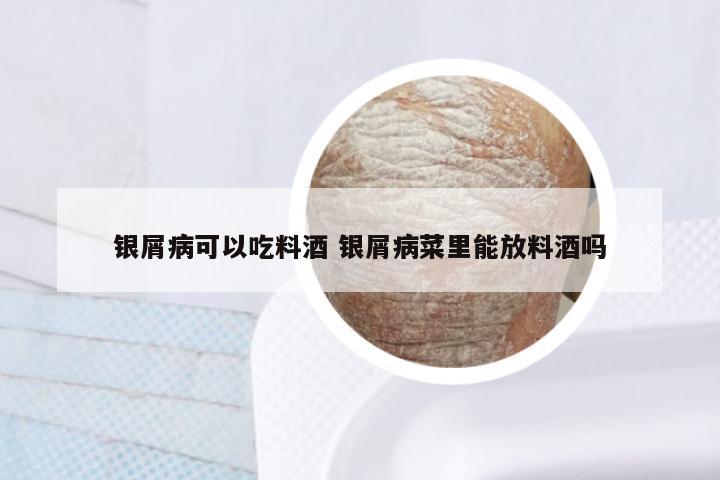 银屑病可以吃料酒 银屑病菜里能放料酒吗