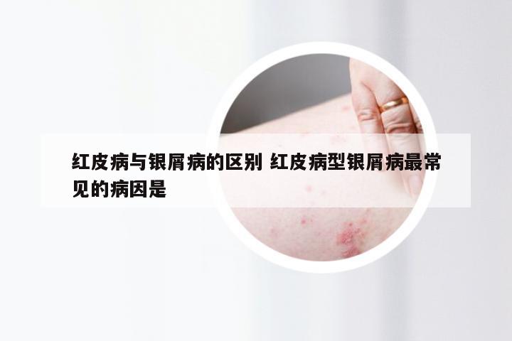 红皮病与银屑病的区别 红皮病型银屑病最常见的病因是