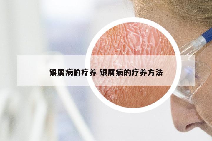 银屑病的疗养 银屑病的疗养方法