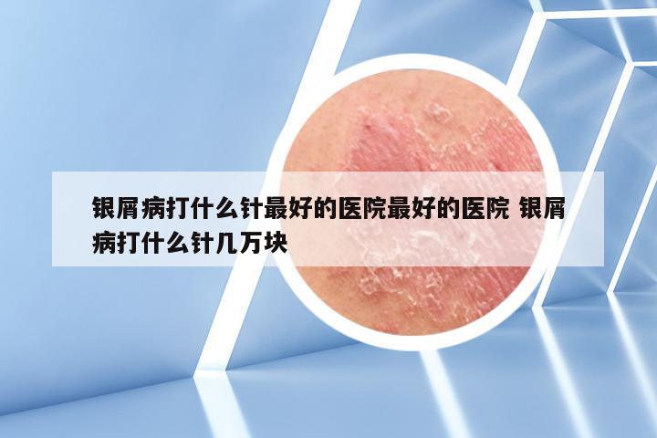银屑病打什么针最好的医院最好的医院 银屑病打什么针几万块