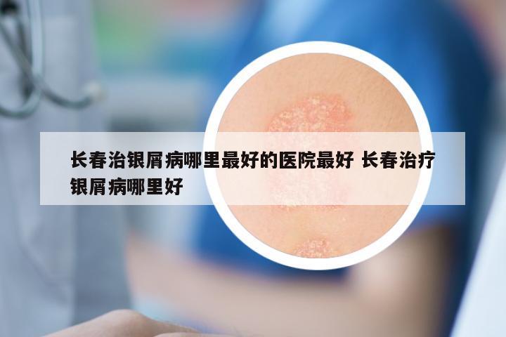 长春治银屑病哪里最好的医院最好 长春治疗银屑病哪里好