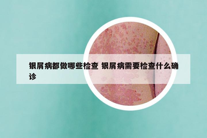 银屑病都做哪些检查 银屑病需要检查什么确诊
