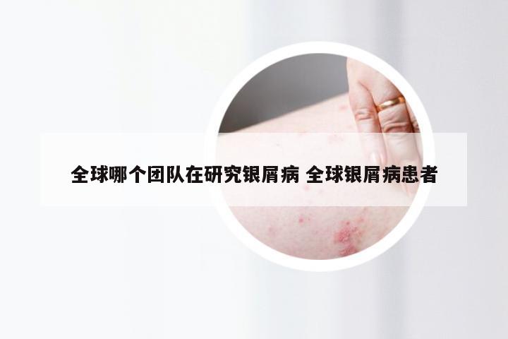 全球哪个团队在研究银屑病 全球银屑病患者