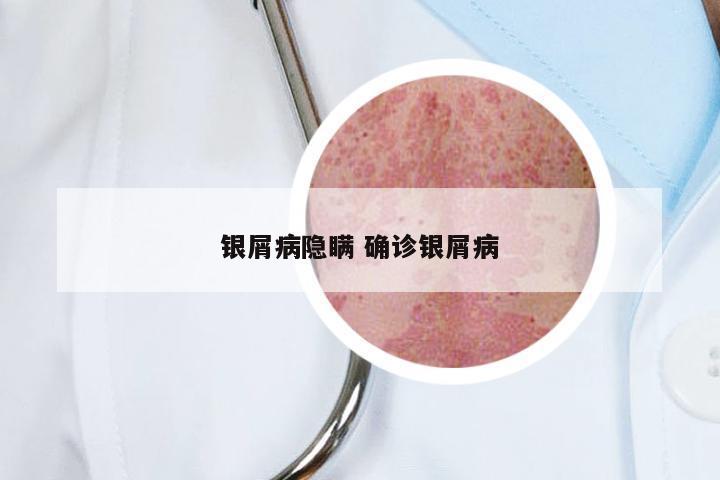 银屑病隐瞒 确诊银屑病