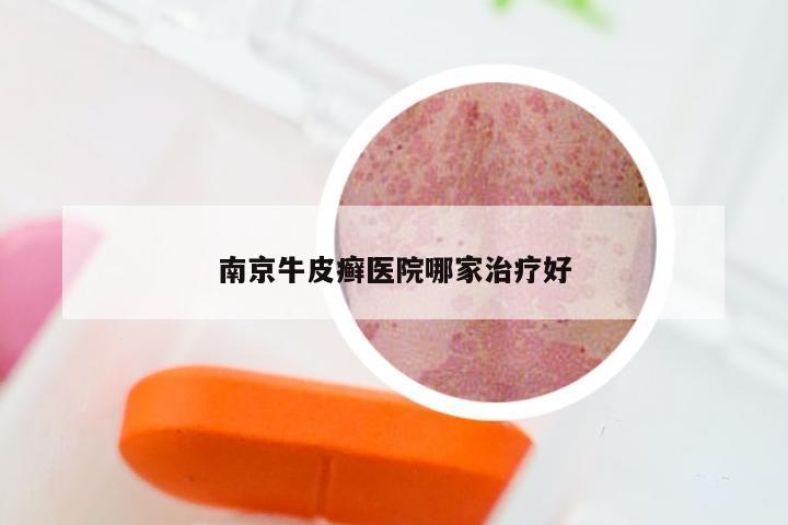 南京牛皮癣医院哪家治疗好