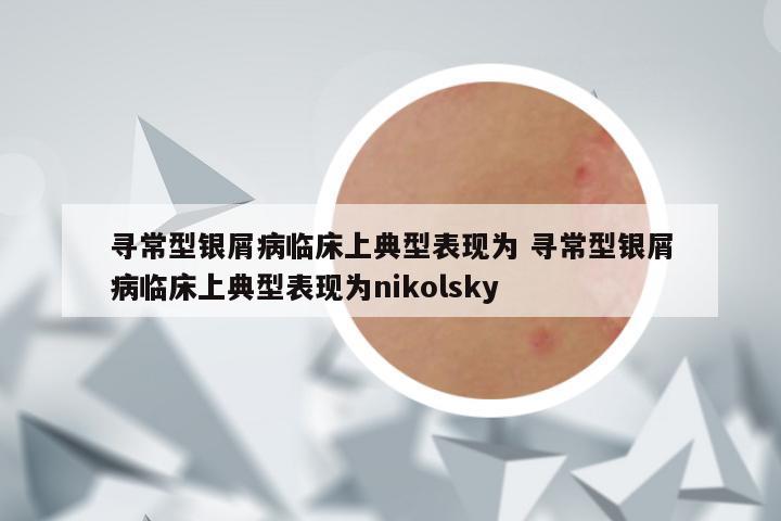 寻常型银屑病临床上典型表现为 寻常型银屑病临床上典型表现为nikolsky