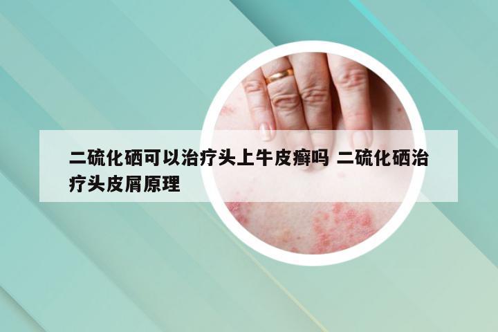 二硫化硒可以治疗头上牛皮癣吗 二硫化硒治疗头皮屑原理