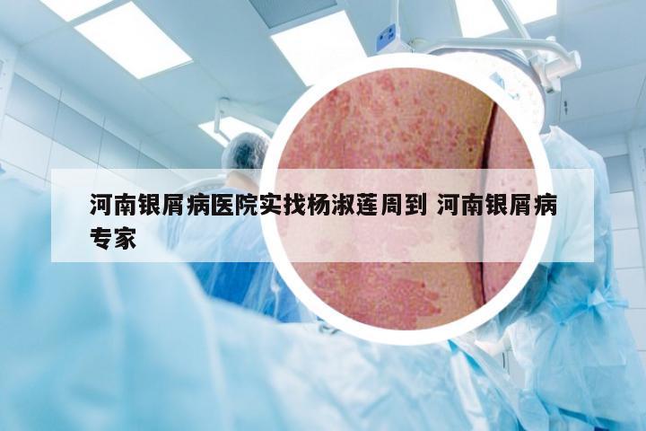 河南银屑病医院实找杨淑莲周到 河南银屑病专家