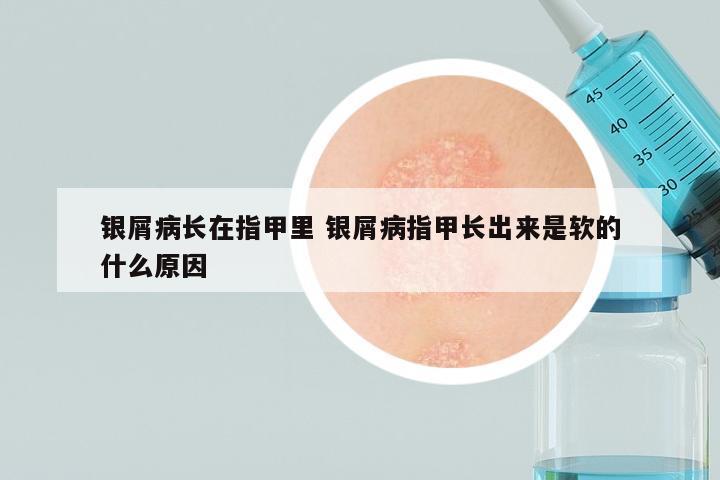 银屑病长在指甲里 银屑病指甲长出来是软的什么原因