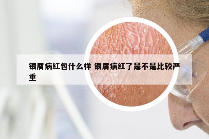 银屑病红包什么样 银屑病红了是不是比较严重