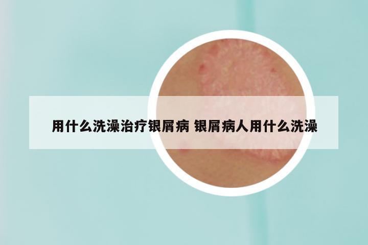 用什么洗澡治疗银屑病 银屑病人用什么洗澡