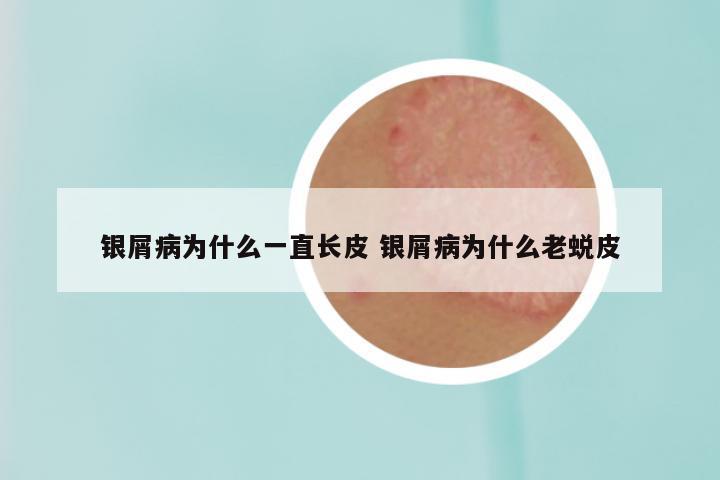 银屑病为什么一直长皮 银屑病为什么老蜕皮