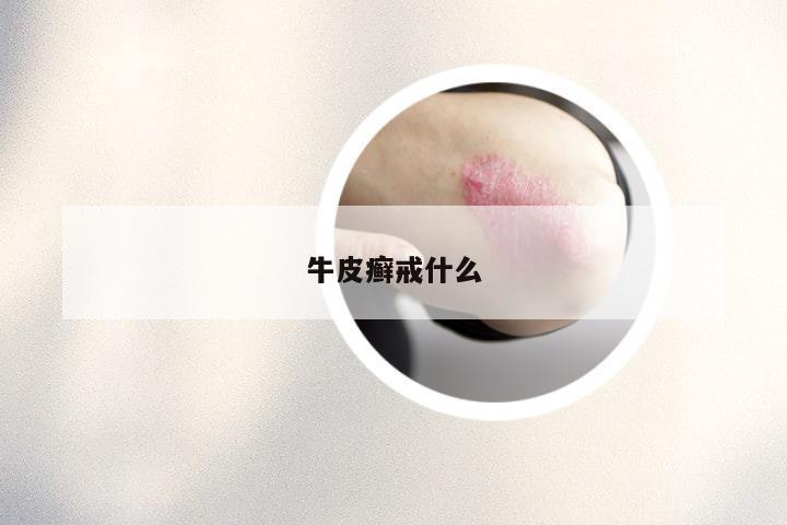 牛皮癣戒什么