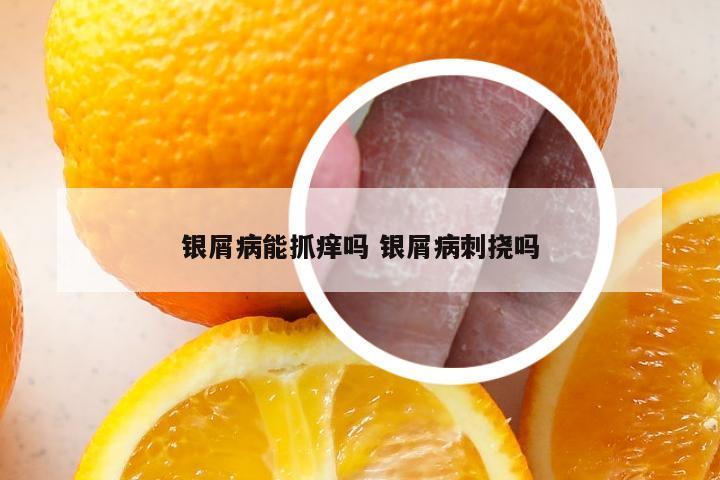 银屑病能抓痒吗 银屑病刺挠吗