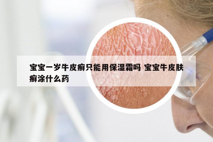 宝宝一岁牛皮癣只能用保湿霜吗 宝宝牛皮肤癣涂什么药