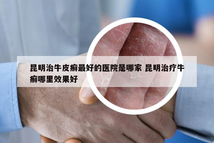 昆明治牛皮癣最好的医院是哪家 昆明治疗牛癣哪里效果好