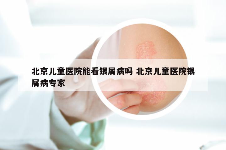 北京儿童医院能看银屑病吗 北京儿童医院银屑病专家