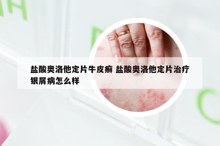 盐酸奥洛他定片牛皮癣 盐酸奥洛他定片治疗银屑病怎么样