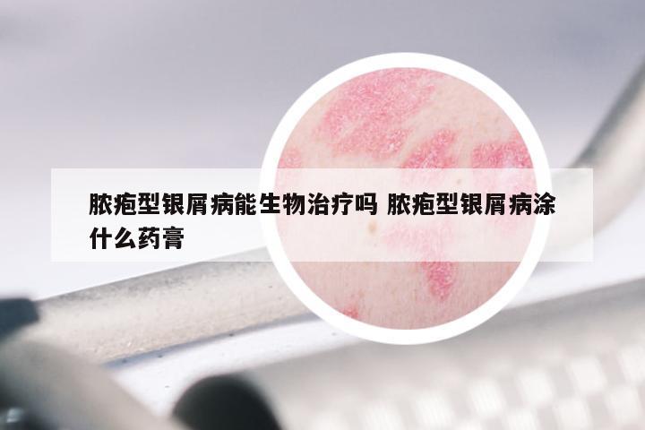 脓疱型银屑病能生物治疗吗 脓疱型银屑病涂什么药膏